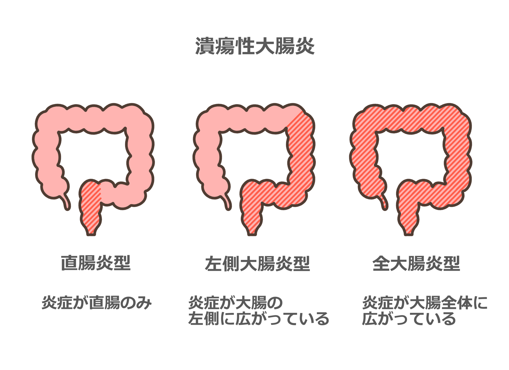 腸が炎症を起こす潰瘍性大腸炎