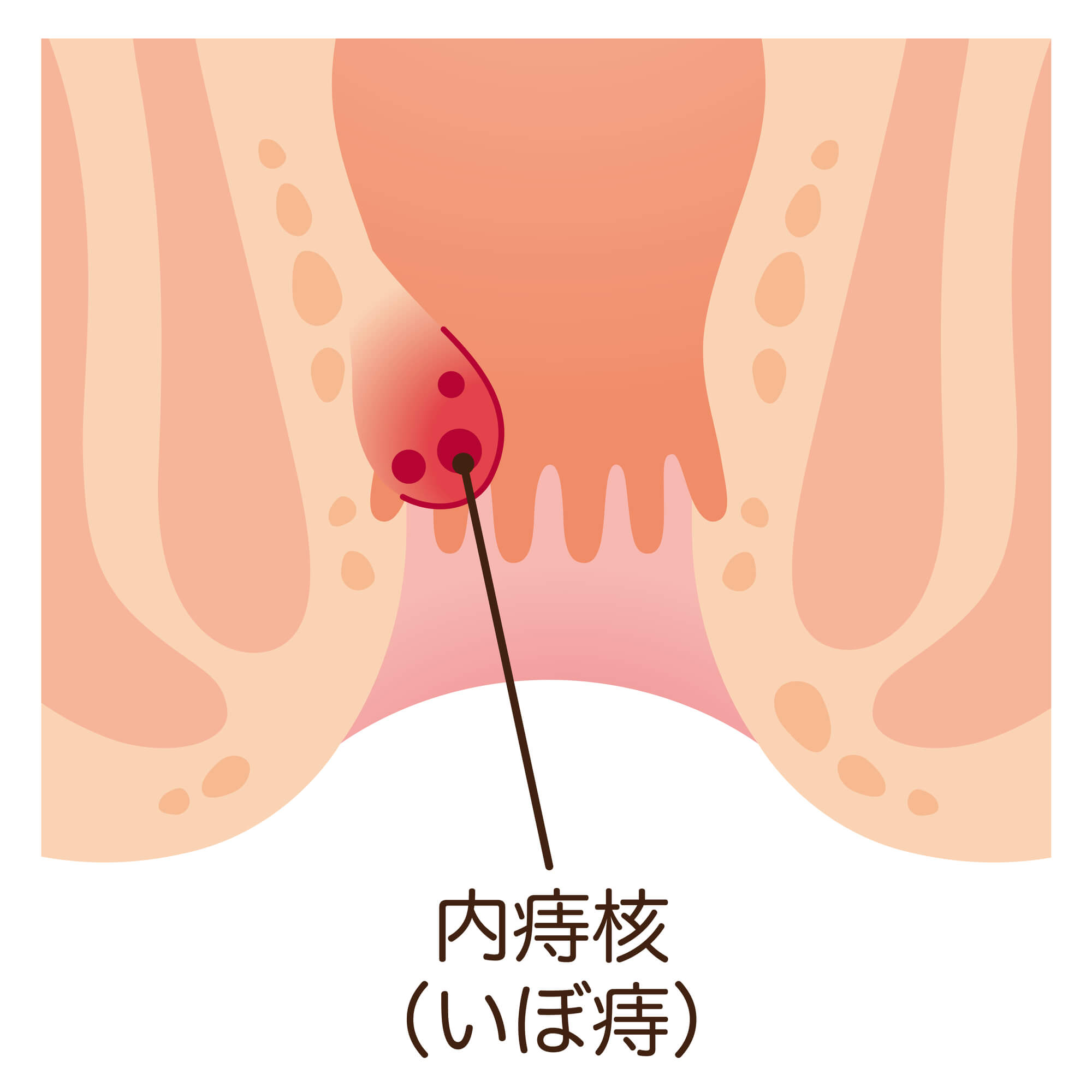 内痔核