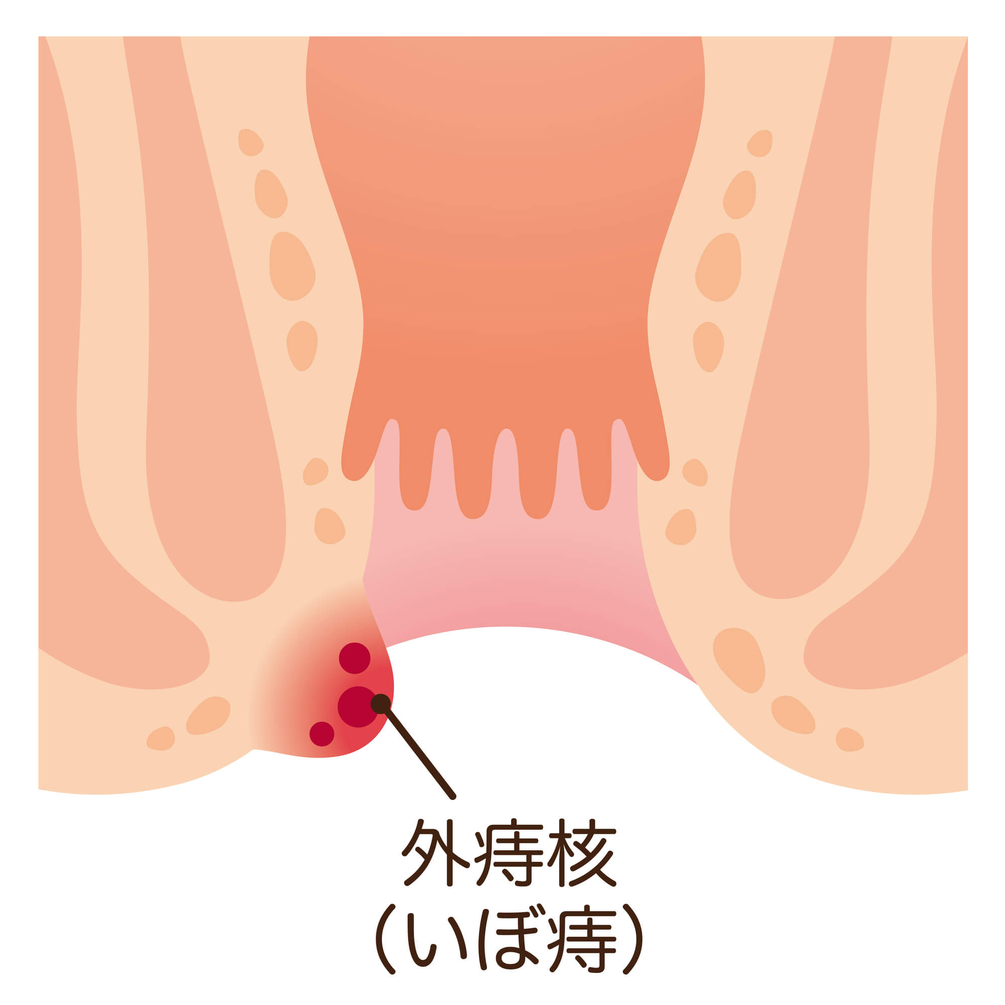 外痔核