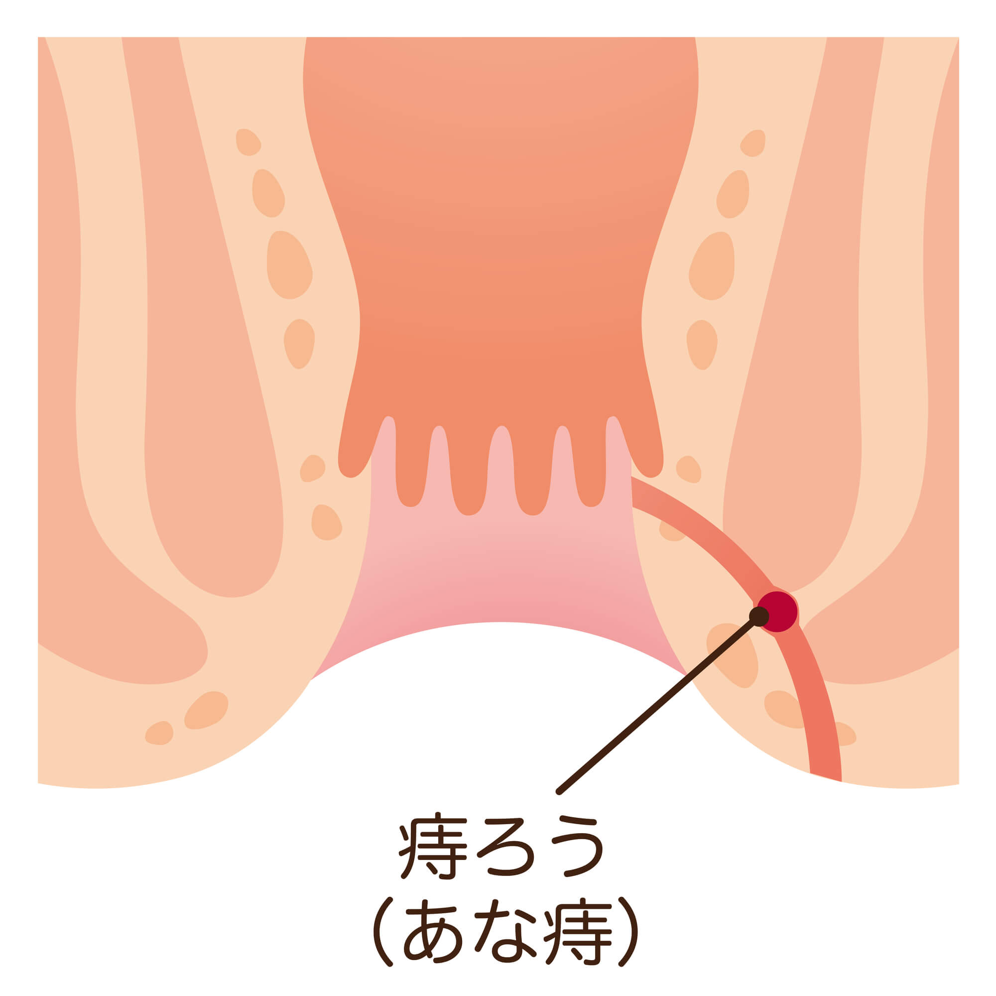 痔ろう（あな痔）