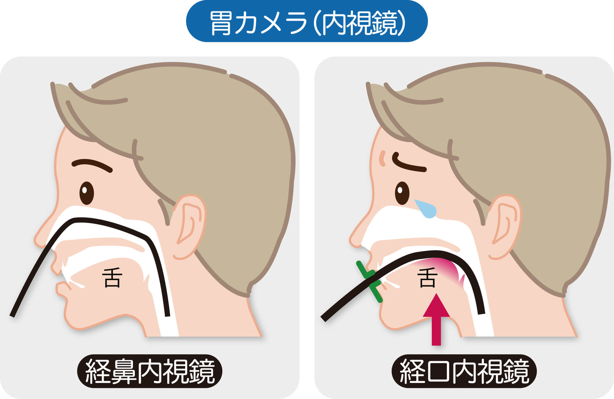 経口・経鼻の胃カメラ選択が可能